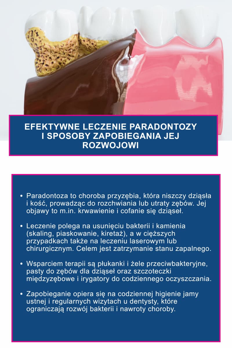 Efektywne leczenie paradontozy i sposoby zapobiegania jej rozwojowi